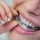 Do’s Don’ts of Invisalign